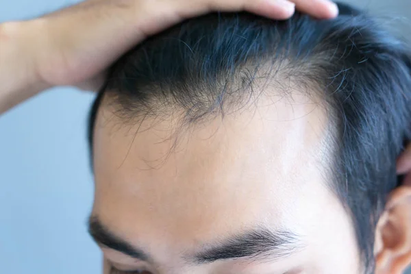 Junger Mann ernstes Haarausfall-Problem für Gesundheitswesen medizinisches und Shampoo-Produktkonzept, selektiver Fokus — Stockfoto