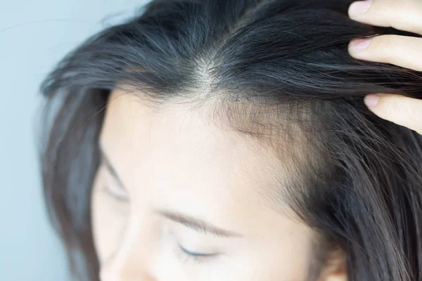 Mulher grave problema de perda de cabelo para cuidados de saúde shampoo e conceito de produto de beleza, foco seletivo — Fotografia de Stock