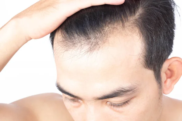 Młody Człowiek Poważny Problem Wypadania Włosów Dla Opieki Zdrowotnej Medycznej — Zdjęcie stockowe