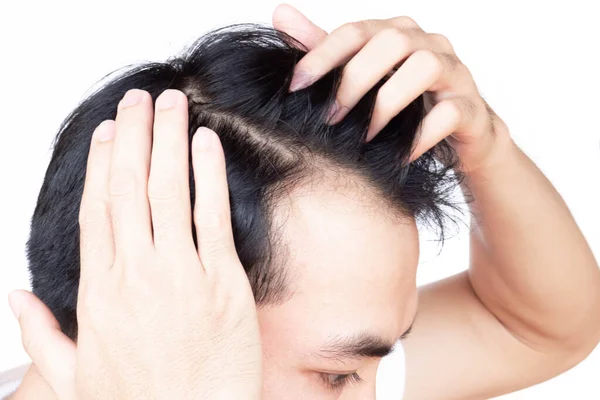 Young Man Serious Hair Loss Problem Health Care Medical Shampoo — Stock Photo, Image
