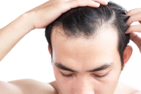 Young Man Serious Hair Loss Problem Health Care Medical Shampoo — Stock Photo, Image