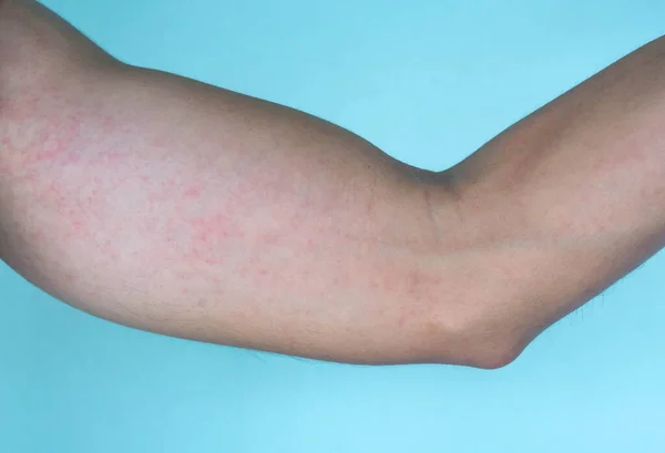 Closeup allergy rash on arm skin, health care and medical concept