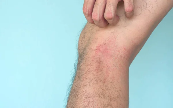Closeup man hand scratching allergy rash on leg skin, health care and medical concept