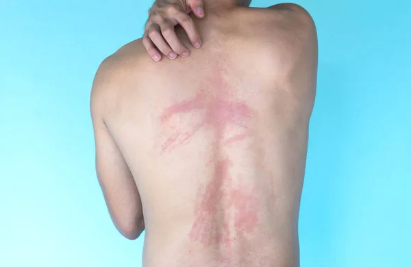 Detailní Alergie Vyrážka Zadní Kůži Zdravotní Péče Lékařské Koncepce — Stock fotografie