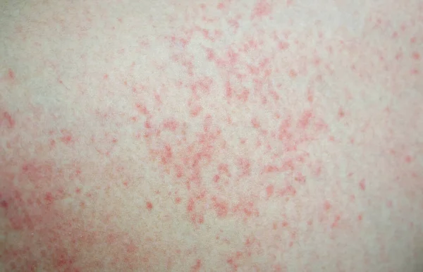 Closeup Allergy Rash Skin Health Care Medical Concept — Stock Photo, Image