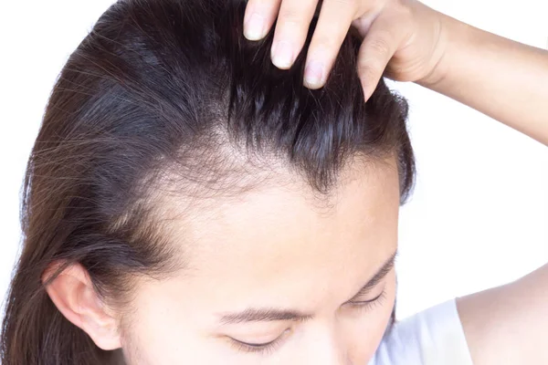 Женщина Серьезная Проблема Потери Волос Здравоохранения Шампунь Косметический Продукт Концепции — стоковое фото