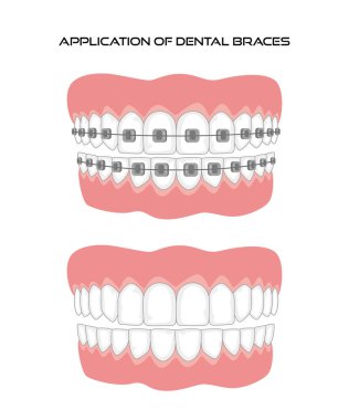 Dişler beyaz arka plan üzerinde diş teli ile. 