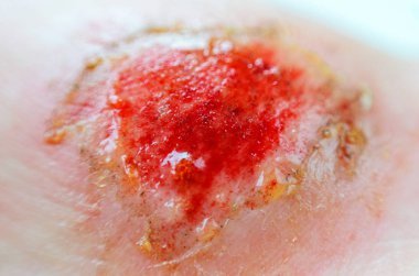 Aşınma. Deride derin yara