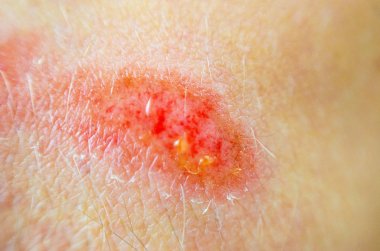 Aşınma. Deride derin yara