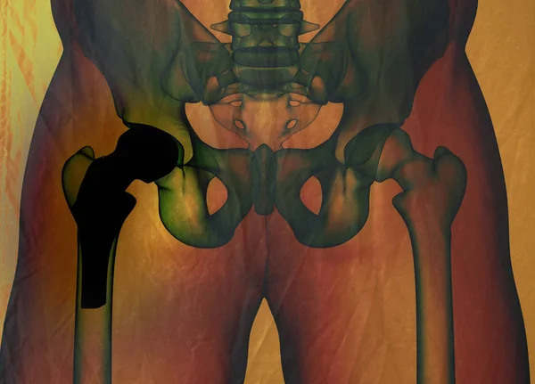 Hip replacement model — Stock Photo, Image