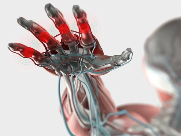 Modelo de anatomía de la mano con artritis — Foto de Stock