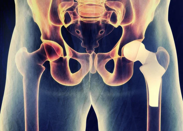 Modello di sostituzione dell'anca — Foto Stock