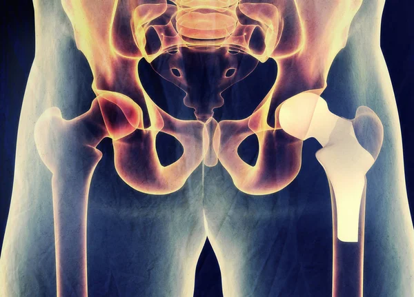Modelo de substituição do quadril — Fotografia de Stock