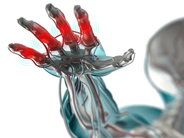 Anatomi handmodell med artrit — Stockfoto