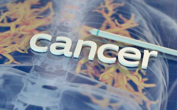 Palabra CANCER en superficie con modelo anatómico — Foto de Stock