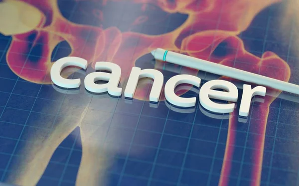 Palabra CANCER en superficie con modelo anatómico — Foto de Stock