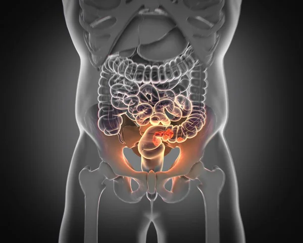 Modelo de anatomía del cáncer colorrectal — Foto de Stock