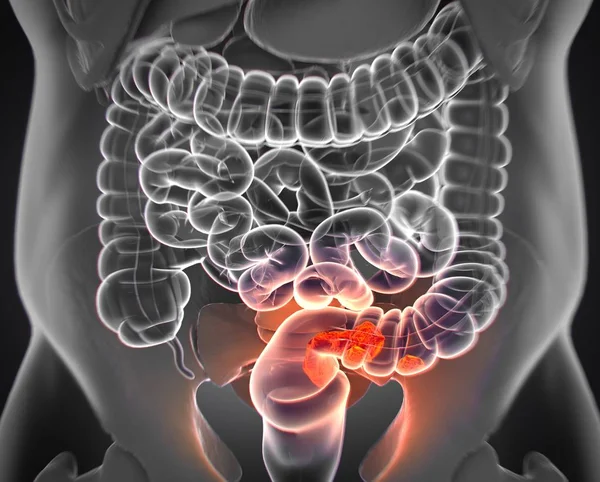 Colorectal cancer anatomy model — Stock Photo, Image