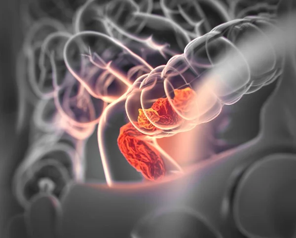 Colorectal cancer anatomy model — Stock Photo, Image