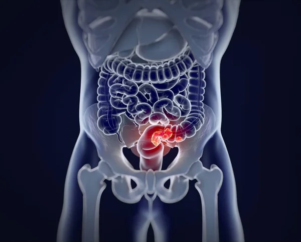 Rak jelita grubego Anatomia modelu — Zdjęcie stockowe