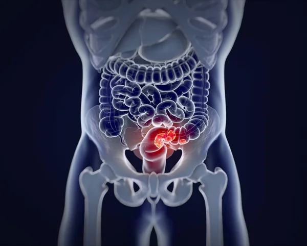 Modelo de anatomia do câncer colorretal — Fotografia de Stock