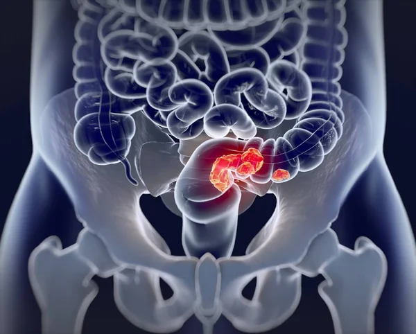 Rak jelita grubego Anatomia modelu — Zdjęcie stockowe