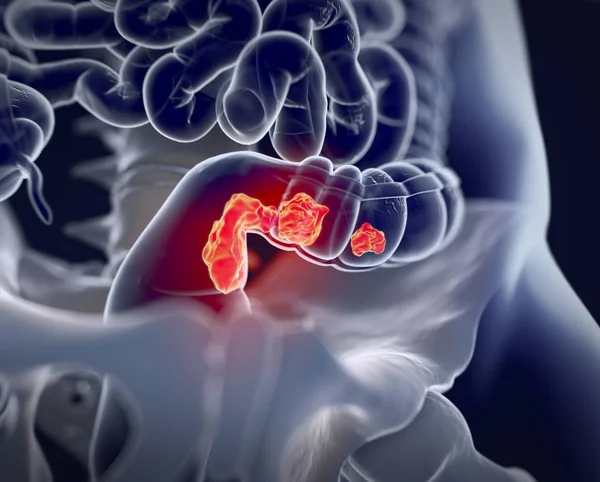 Modelo de anatomia do câncer colorretal — Fotografia de Stock