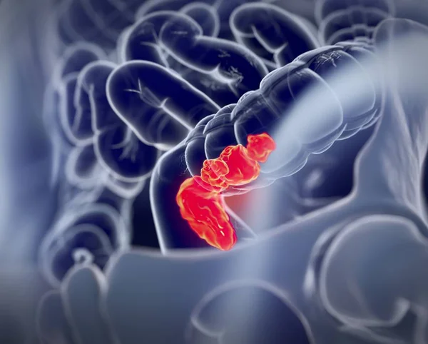 Rak jelita grubego Anatomia modelu — Zdjęcie stockowe