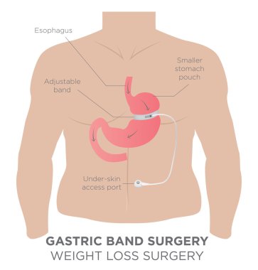 Gastrik Band kilo kaybı cerrahi