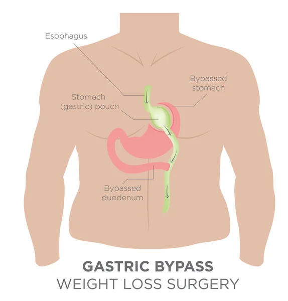 Chirurgie gastrique de perte de poids — Image vectorielle