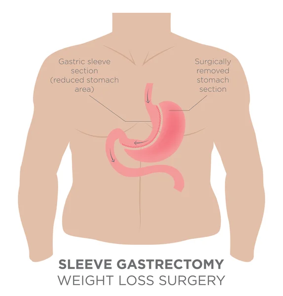 Maag nietje bariatrische chirurgie — Stockvector