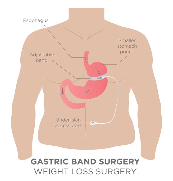 Banda gástrica Cirugía de pérdida de peso — Vector de stock