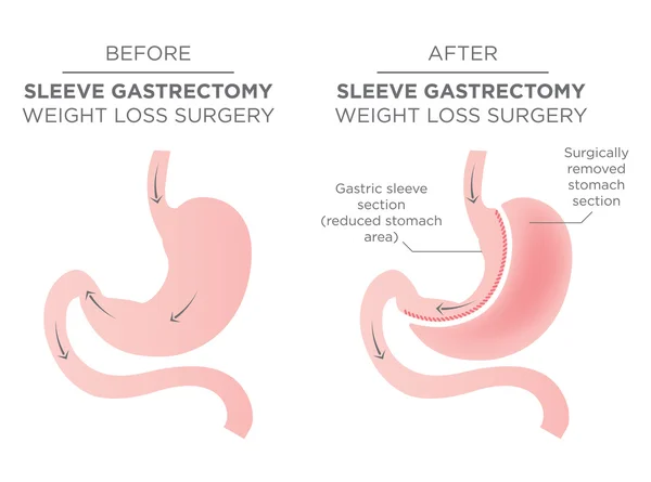 Střížová bariatrické operaci žaludku — Stockový vektor