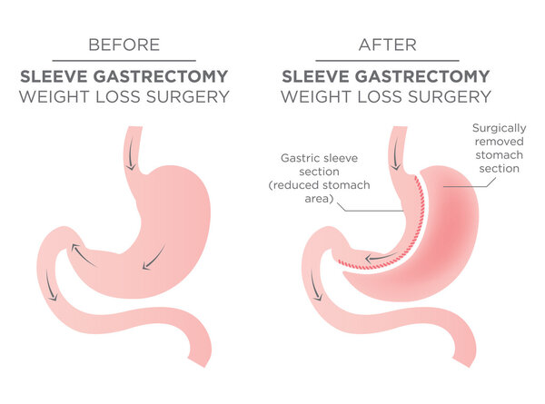 Stomach Staple Bariatric Surgery