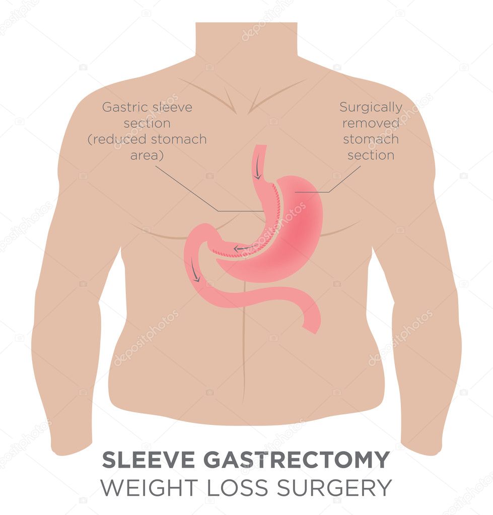 Stomach Staple Bariatric Surgery