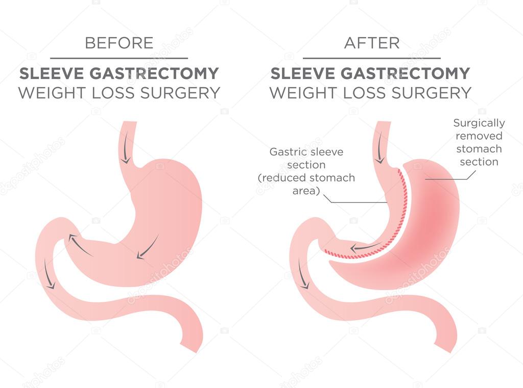 Stomach Staple Bariatric Surgery
