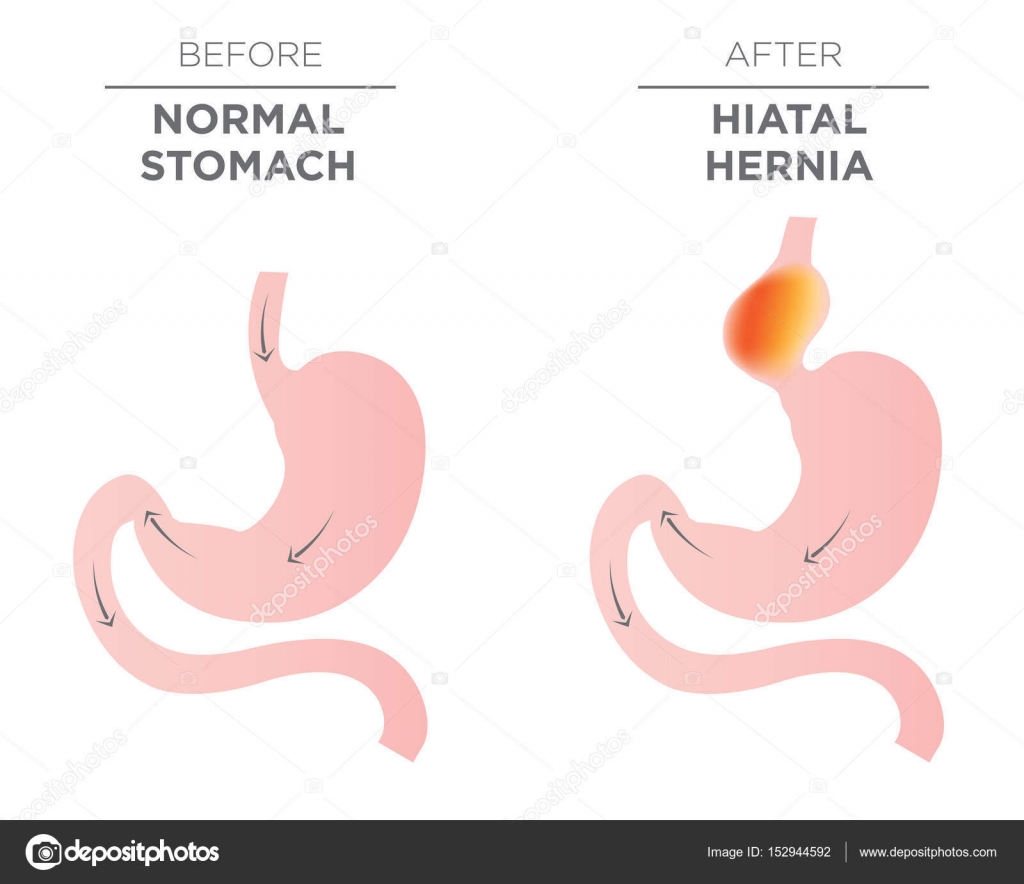 Hiatus Hernia Stomach Image Stock Vector Image by ©bearsky23@yahoo.com ...