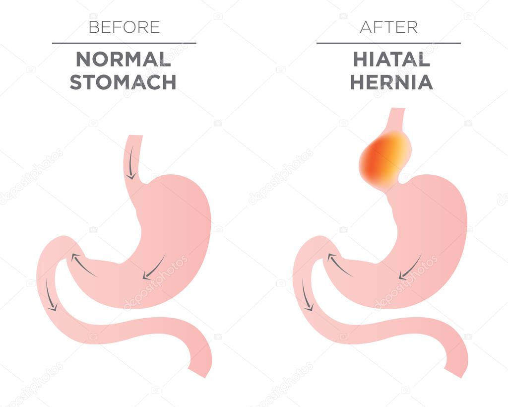 Hiatus Hernia Stomach Image — Stock Vector © bearsky23@yahoo.com #152944592