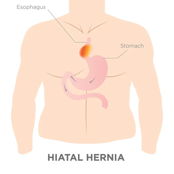 Hiatus Hernia gyomor kép — Stock Vector
