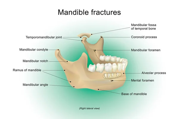 Fracturas de mandíbula. Diseño de vectores de anatomía, Ilustración . — Vector de stock