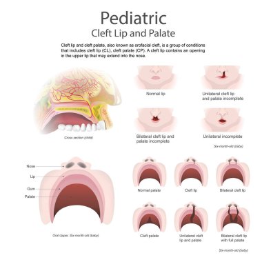 Cleft lip and cleft palate. Vector Arts, Illustration. clipart