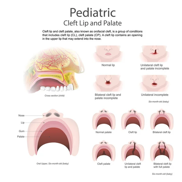 Labio leporino y paladar hendido. Artes vectoriales, ilustración . — Archivo Imágenes Vectoriales