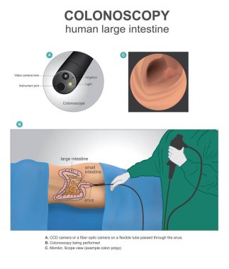 Kolonoskopi, insan anatomisi illüstrasyon, vektör sanat.