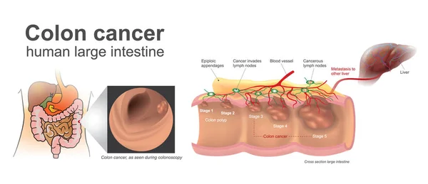 Cancro do cólon humano. Anatomia Ilustração, arte vetorial . — Vetor de Stock