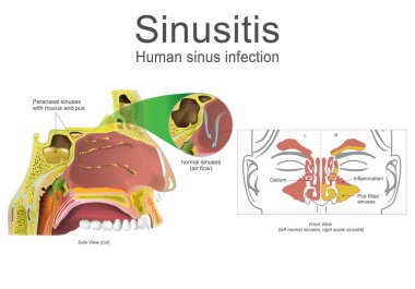 İnsan sinüzit, iltihap. İllüstrasyon, vektör sanat.