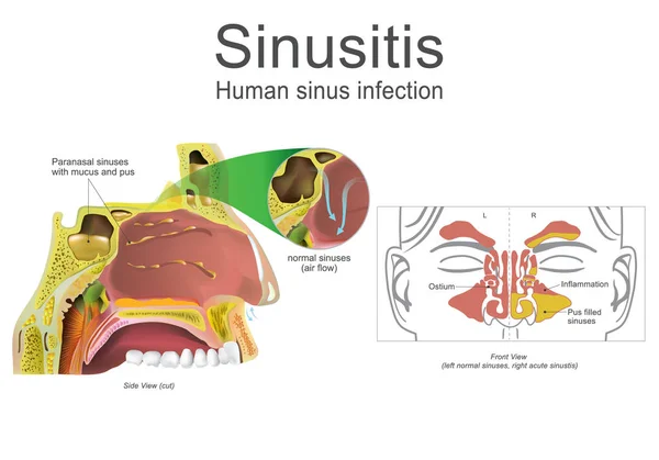 Sinusite humaine, inflammation. Illustration, Art vectoriel . — Image vectorielle