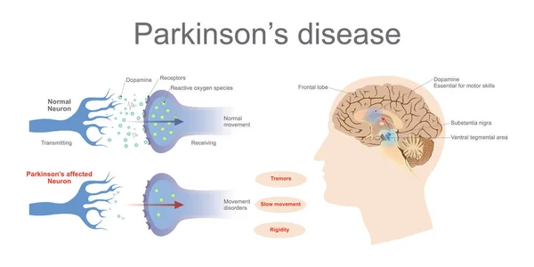 Doença de Parkinson — Vetor de Stock