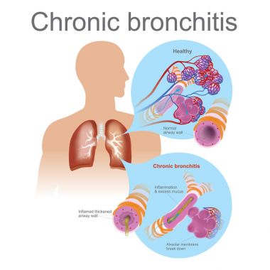 Chronic bronchitis.Vector graphic, Illustrator clipart