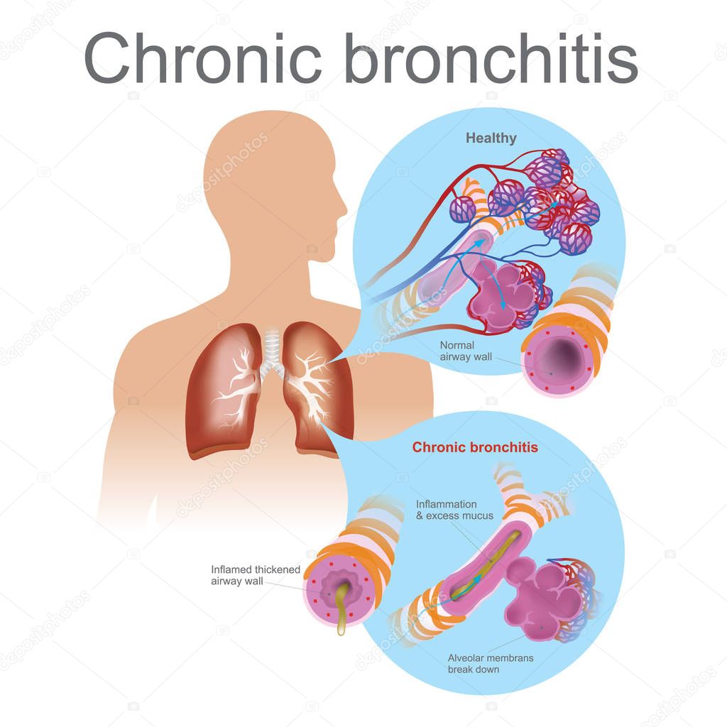 Chronic bronchitis.Vector graphic, Illustrator — Stock Vector