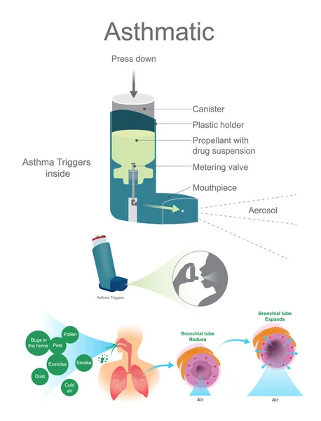 哮喘气道。哮喘触发器内部视图. — 图库矢量图片
